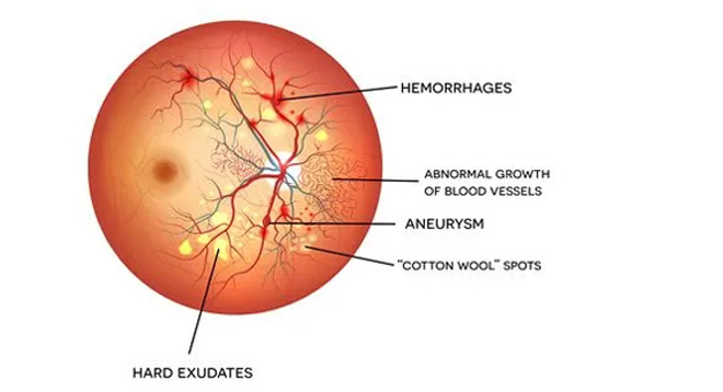 Diabetic Retinopathy retina